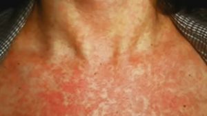 measles-FST2 - TA NEA - TA NEA